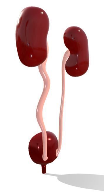 Type 4 - Vesicoureteral Reflux - VUR - Pediatric Surgery 3D model_5