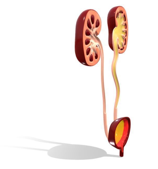 Type 4 - Vesicoureteral Reflux - VUR - Pediatric Surgery 3D model_3