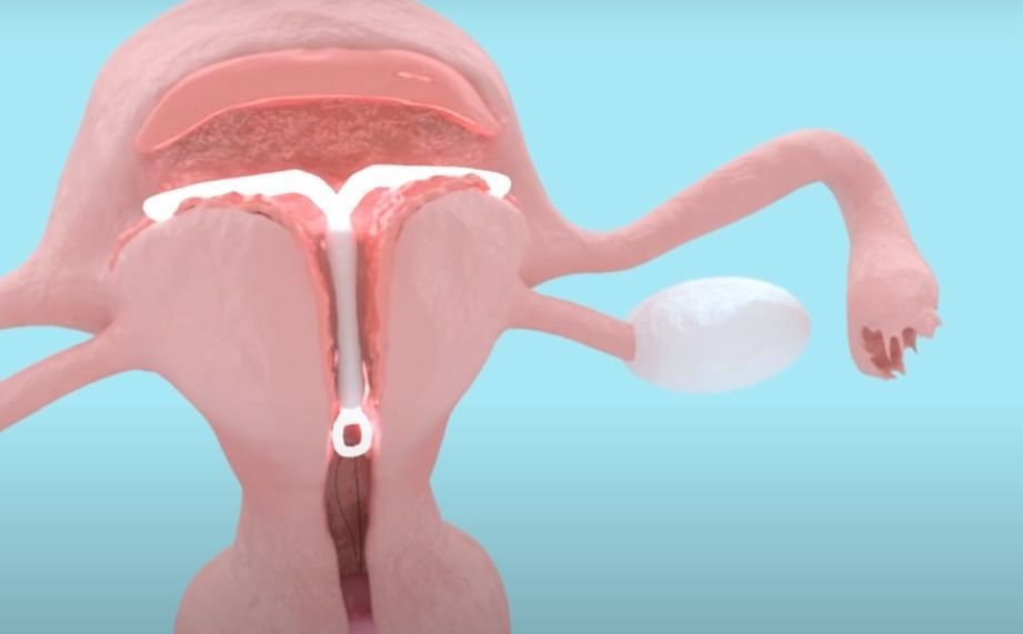 Animated Uterus and Mirena IUD Animable 3D model_1