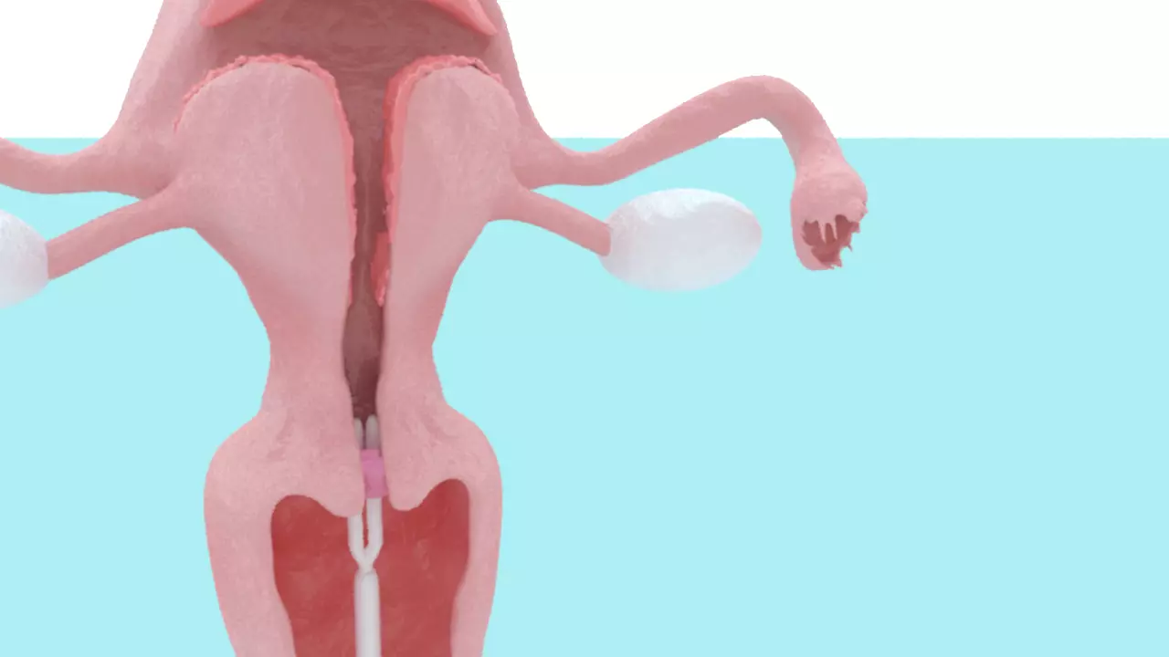 Animated Uterus and Mirena IUD Animable 3D model_0