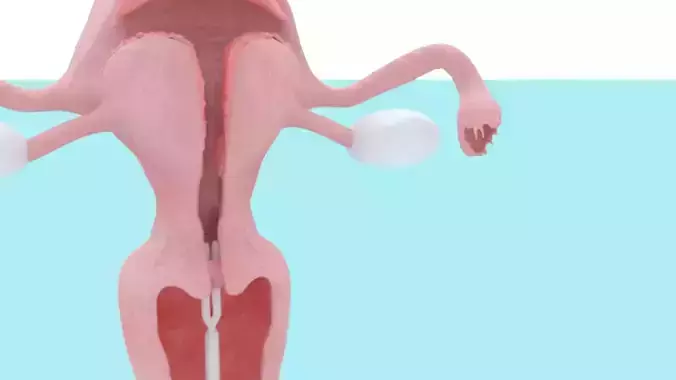 Animated Uterus and Mirena IUD Animable
