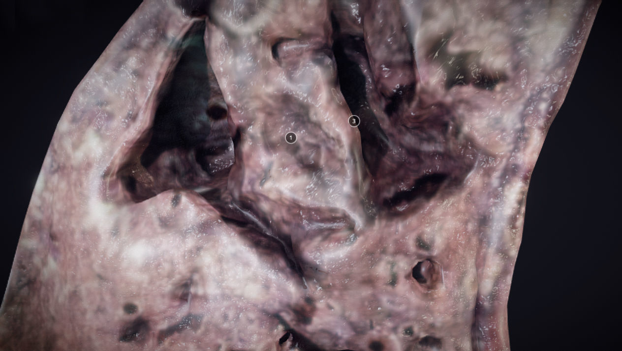 Lung Tuberculosis Low-poly 3D model_13