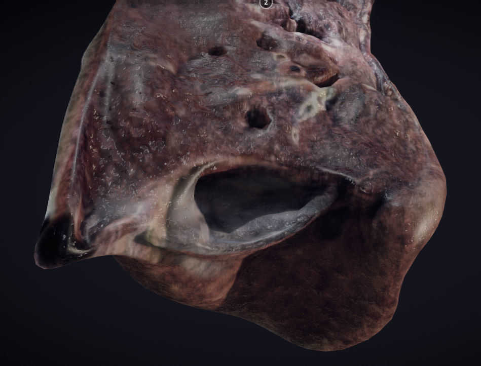 Lung Tuberculosis Low-poly 3D model_5