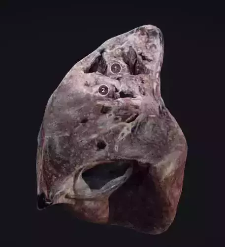 Lung Tuberculosis Low-poly 3D model