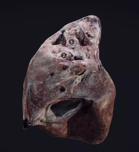 Lung Tuberculosis Low-poly 3D model_0