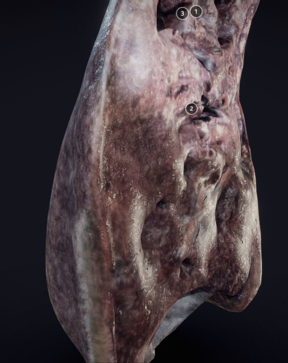 Lung Tuberculosis Low-poly 3D model_4