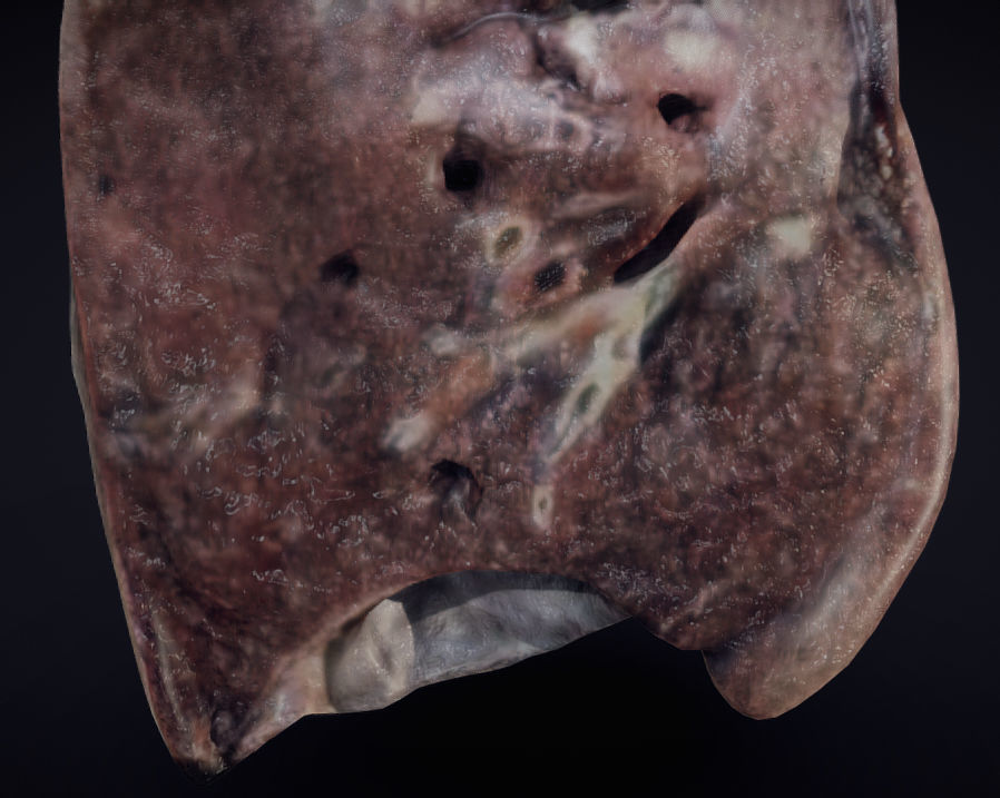 Lung Tuberculosis Low-poly 3D model_7