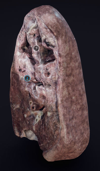 Lung Tuberculosis Low-poly 3D model_3