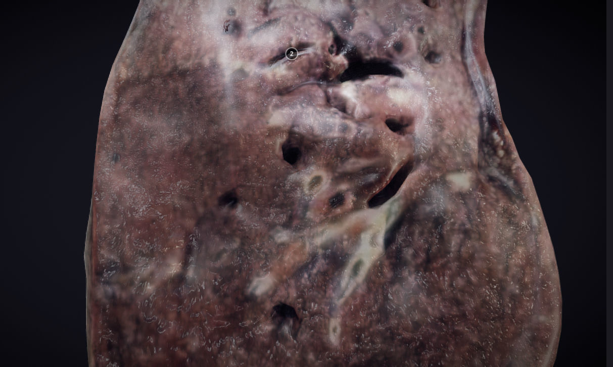 Lung Tuberculosis Low-poly 3D model_12