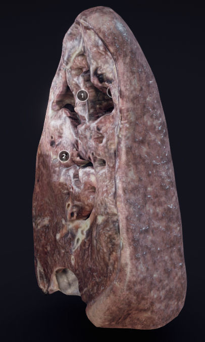 Lung Tuberculosis Low-poly 3D model_10