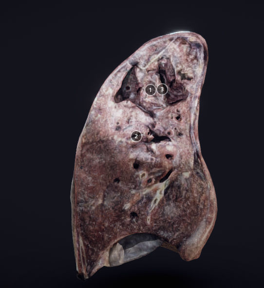 Lung Tuberculosis Low-poly 3D model_1