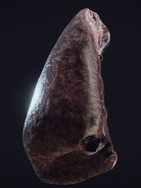 Lung Tuberculosis Low-poly 3D model_11