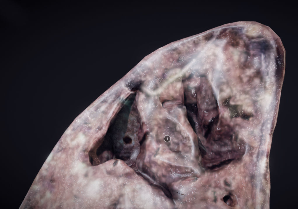 Lung Tuberculosis Low-poly 3D model_6