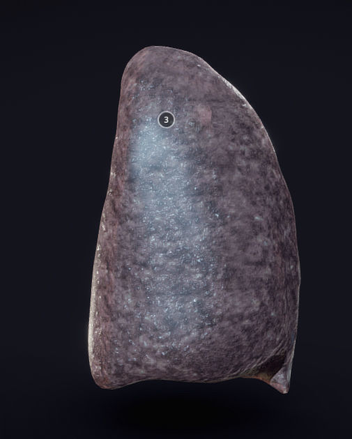 Lung Tuberculosis Low-poly 3D model_2