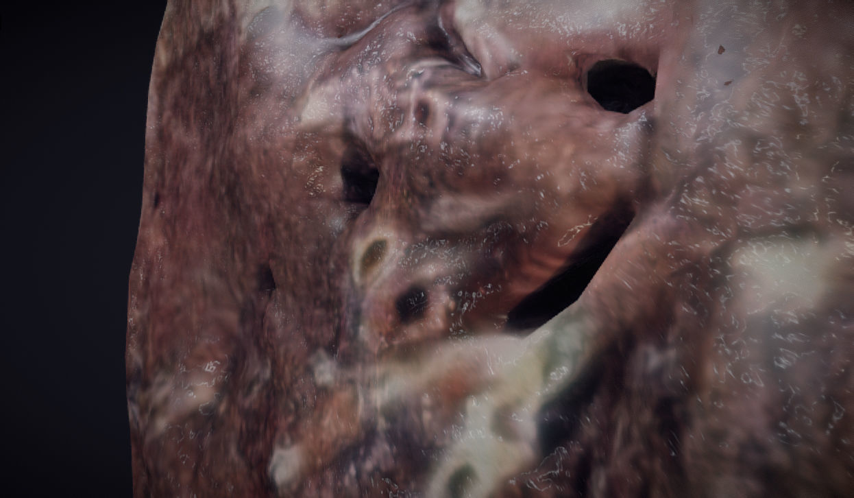 Lung Tuberculosis Low-poly 3D model_9