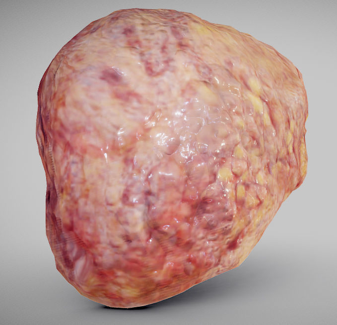 Fatty Liver Low-poly 3D model_1