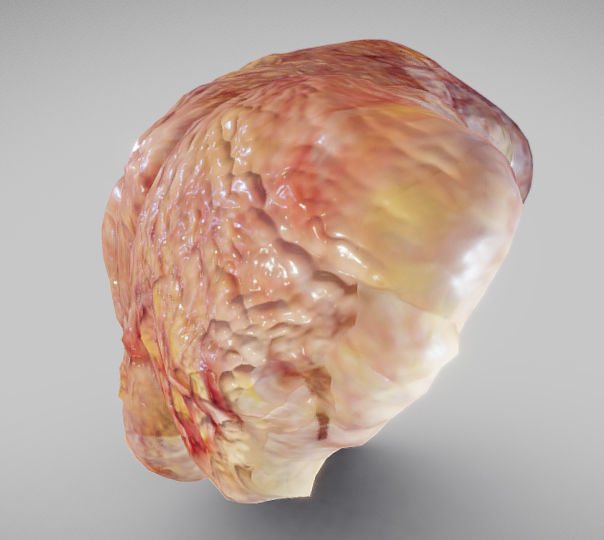 Fatty Liver Low-poly 3D model_11
