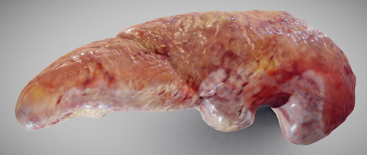 Fatty Liver Low-poly 3D model_4