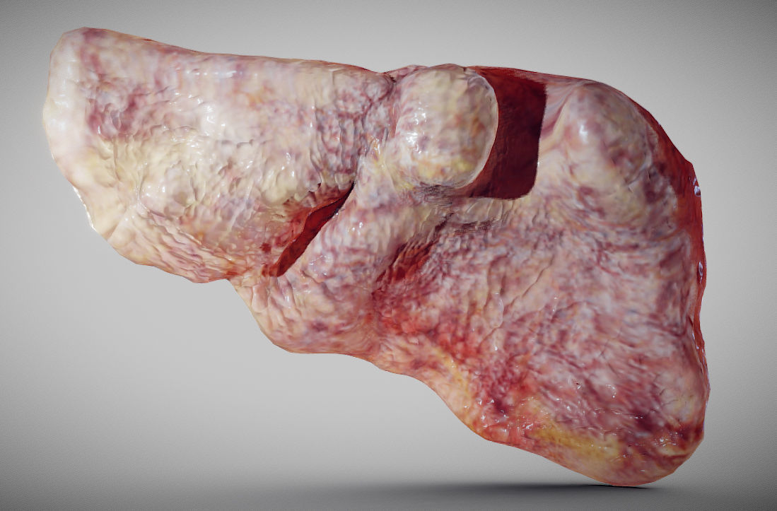 Fatty Liver Low-poly 3D model_12