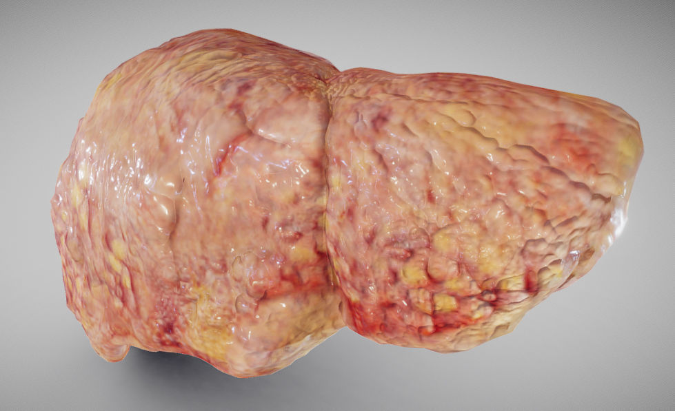 Fatty Liver Low-poly 3D model_9