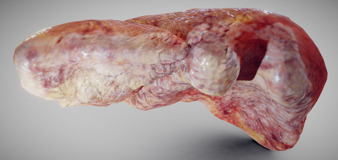 Fatty Liver Low-poly 3D model_5