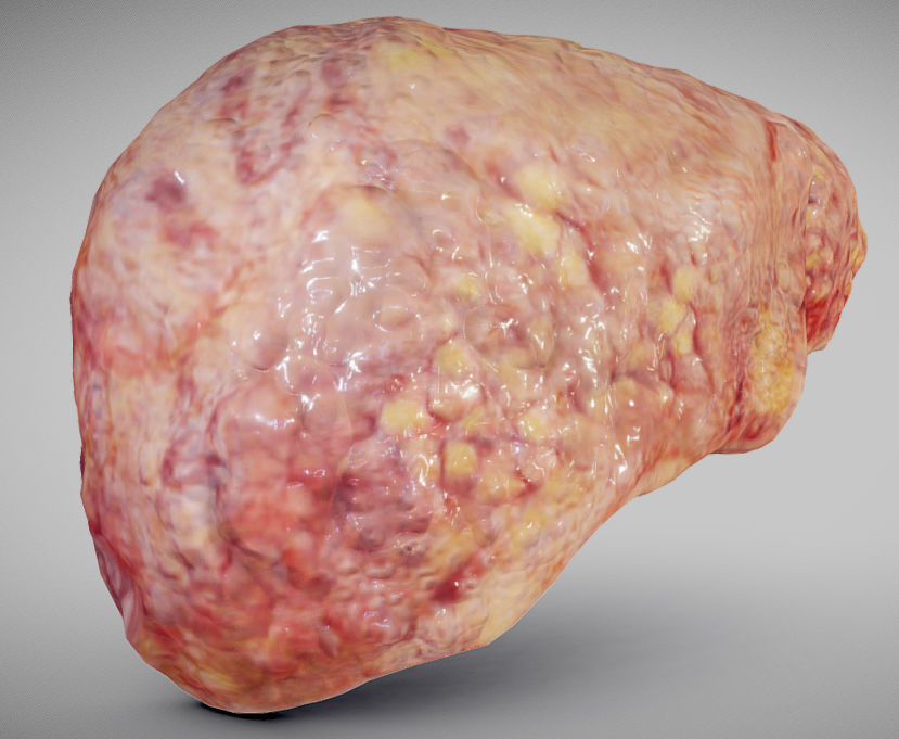 Fatty Liver Low-poly 3D model_2