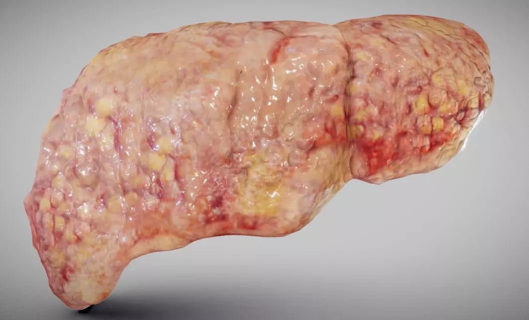 Fatty Liver Low-poly 3D model_0