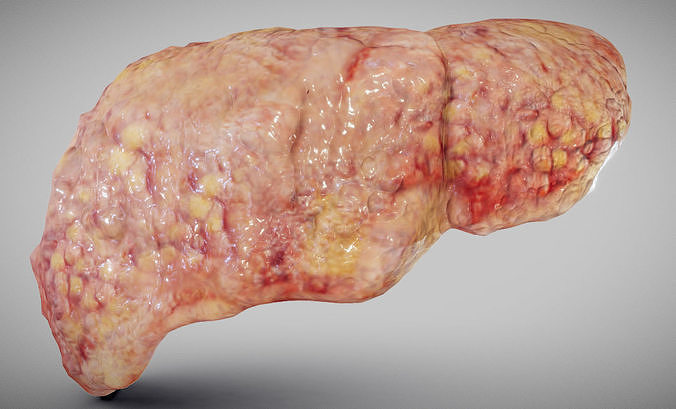 Fatty Liver Low-poly 3D model