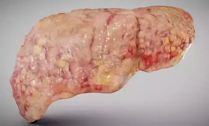 Fatty Liver Low-poly 3D model