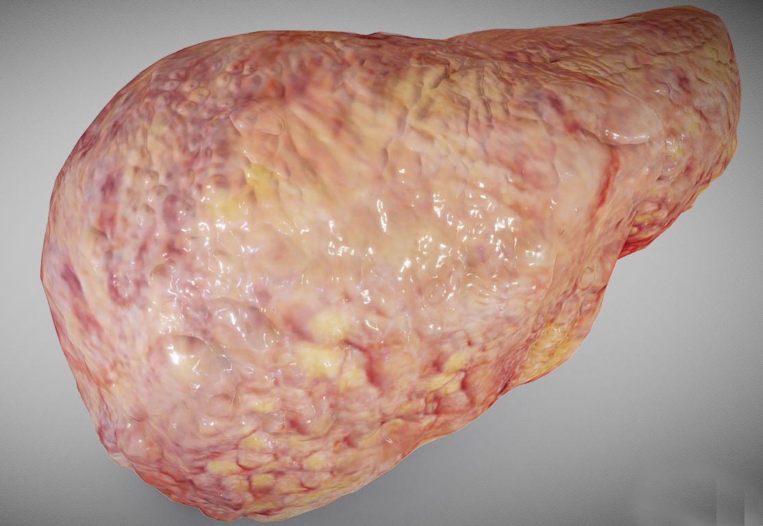 Fatty Liver Low-poly 3D model_7