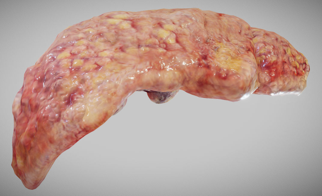 Fatty Liver Low-poly 3D model_3