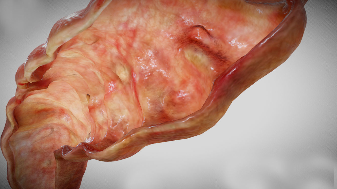 Ulcerative Colitis Low-poly 3D model_12