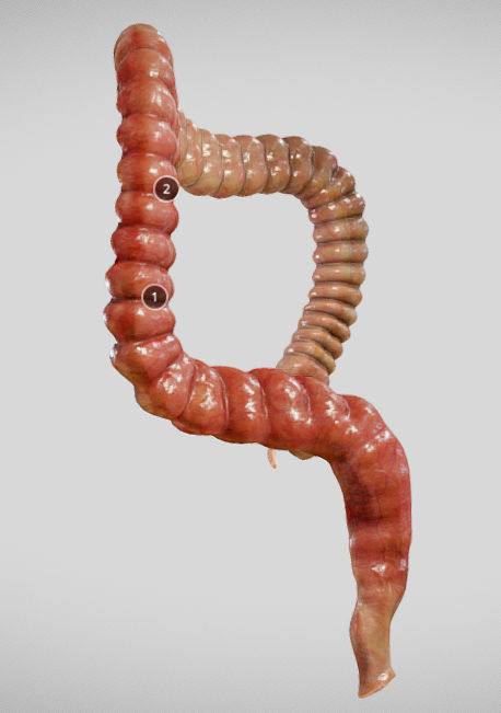 Ulcerative Colitis Low-poly 3D model_26
