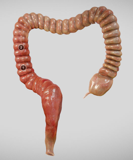Ulcerative Colitis Low-poly 3D model_29