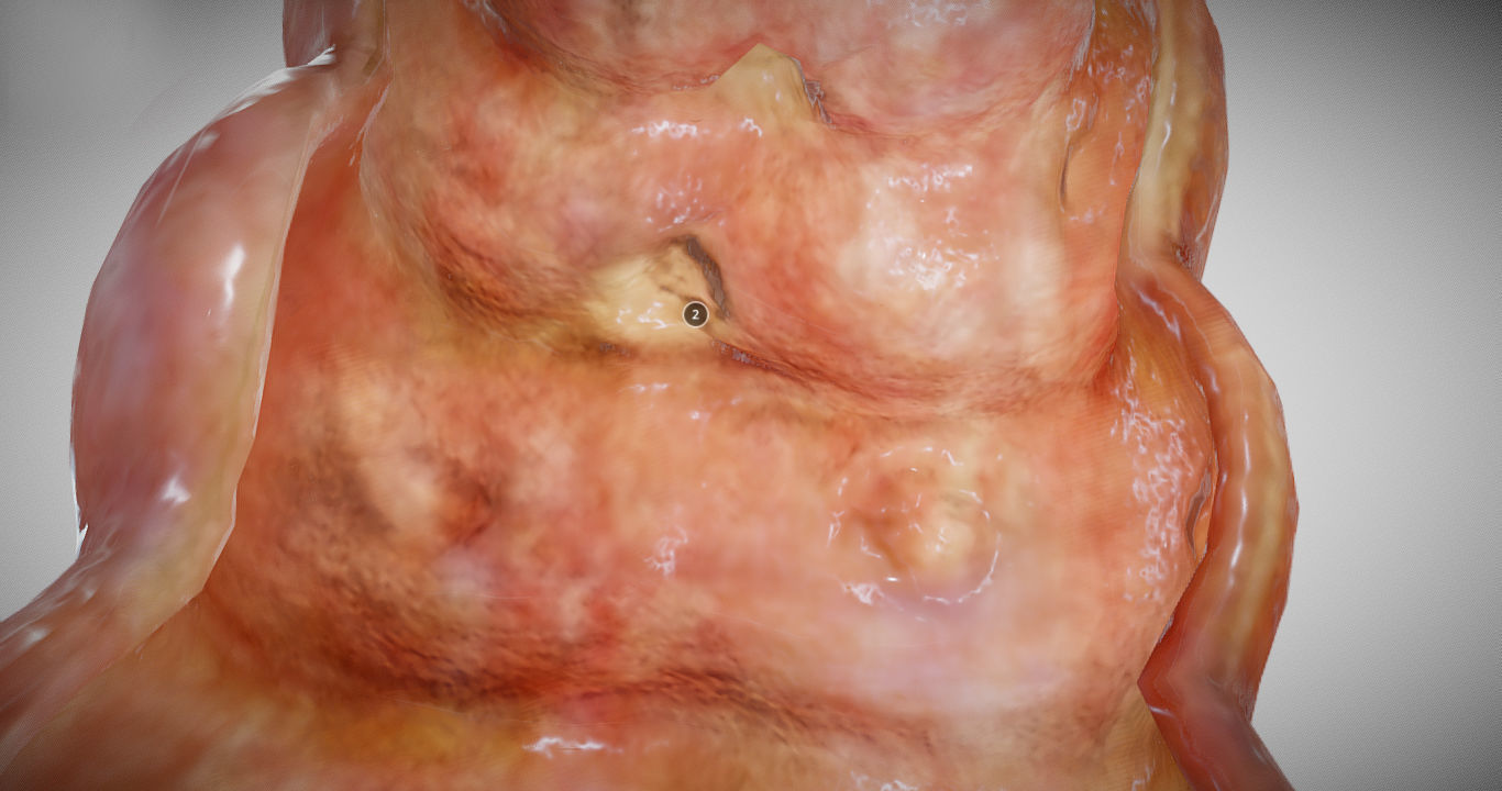 Ulcerative Colitis Low-poly 3D model_21