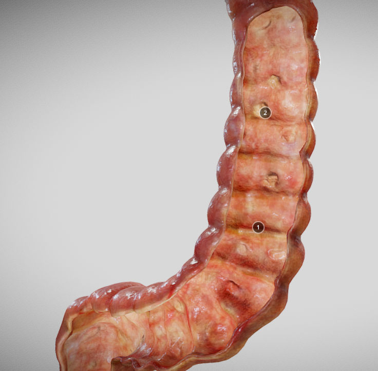 Ulcerative Colitis Low-poly 3D model_10