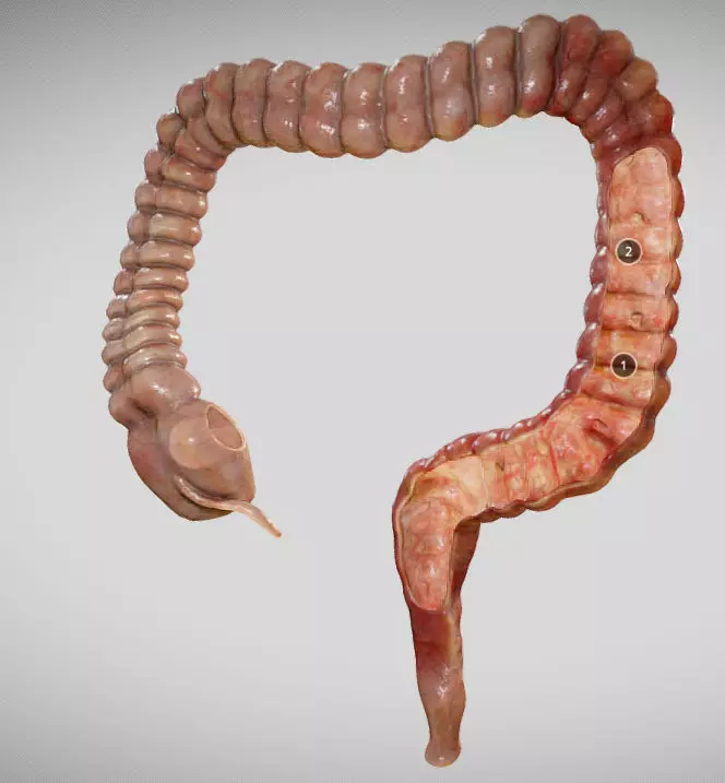 Ulcerative Colitis Low-poly 3D model_0