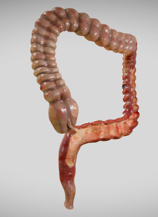 Ulcerative Colitis Low-poly 3D model_4