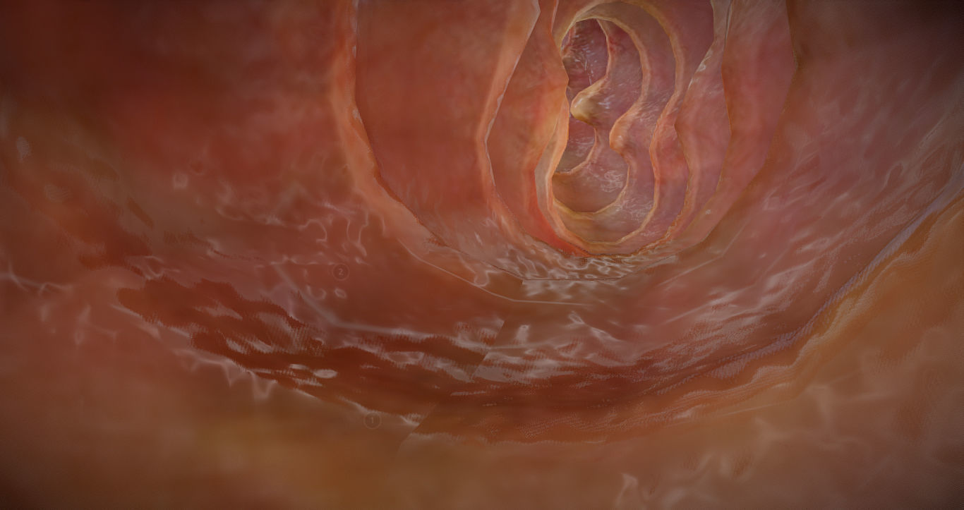 Ulcerative Colitis Low-poly 3D model_19