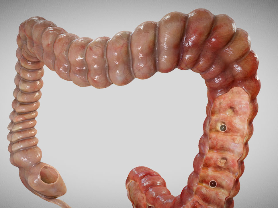 Ulcerative Colitis Low-poly 3D model_18