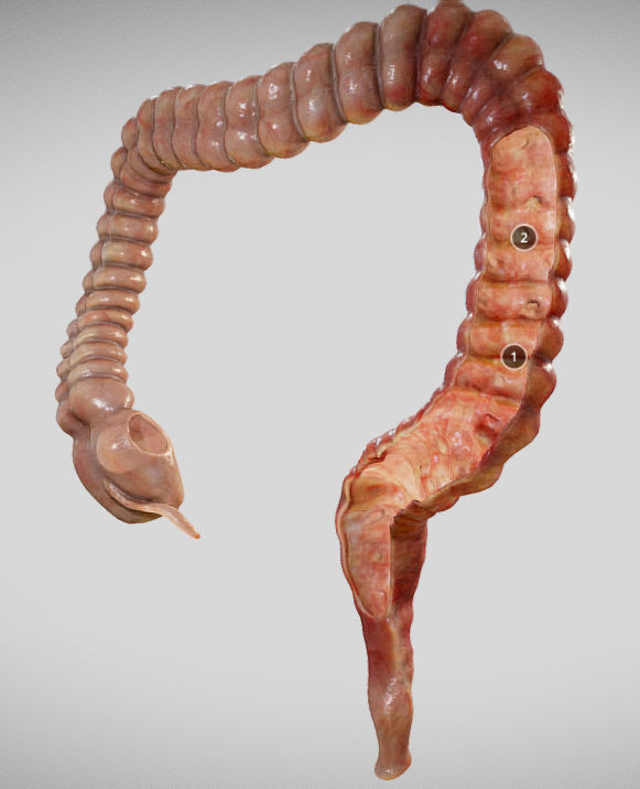 Ulcerative Colitis Low-poly 3D model_11