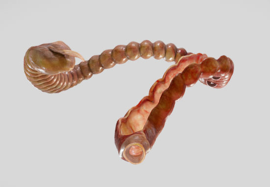 Ulcerative Colitis Low-poly 3D model_6