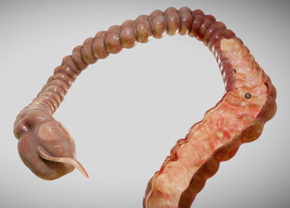 Ulcerative Colitis Low-poly 3D model_14