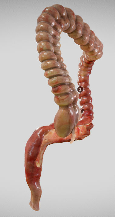 Ulcerative Colitis Low-poly 3D model_3
