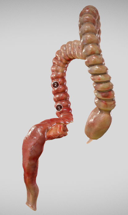 Ulcerative Colitis Low-poly 3D model_2