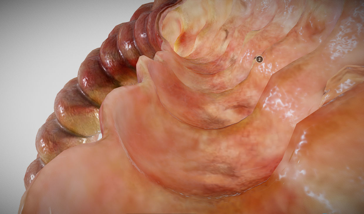 Ulcerative Colitis Low-poly 3D model_20