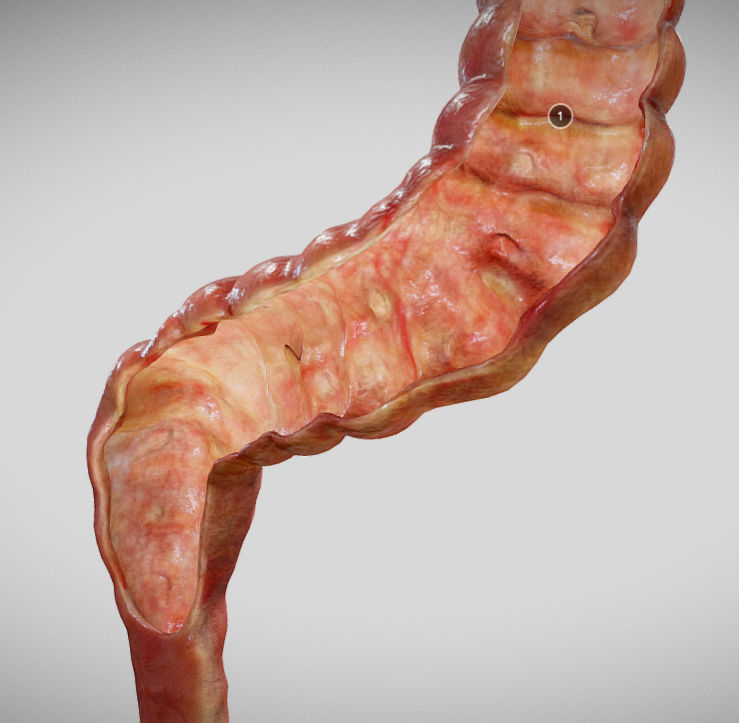 Ulcerative Colitis Low-poly 3D model_9