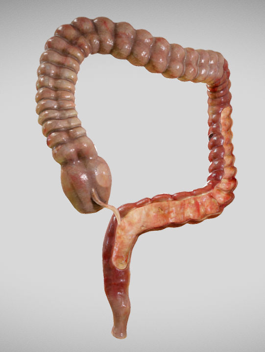 Ulcerative Colitis Low-poly 3D model_5