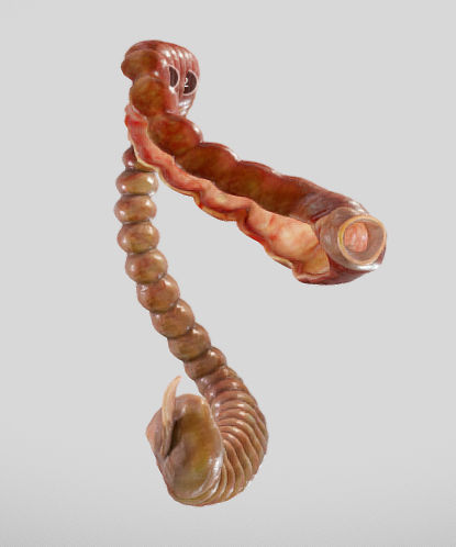 Ulcerative Colitis Low-poly 3D model_7