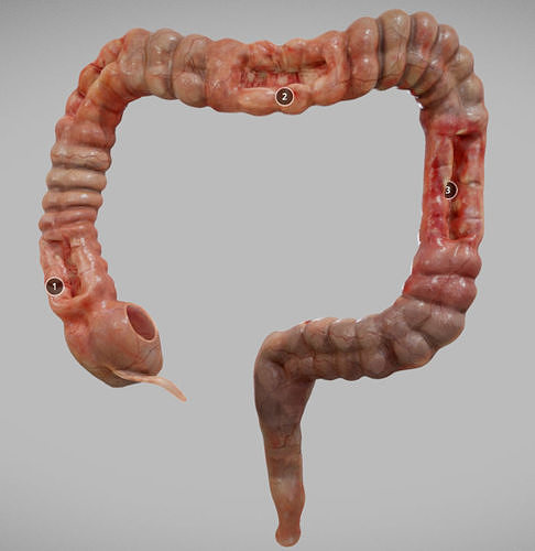 Crohns Disease Low-poly 3D model